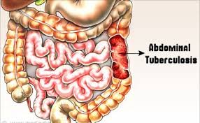 Abdominal TB is a great mimicker of other diseases
